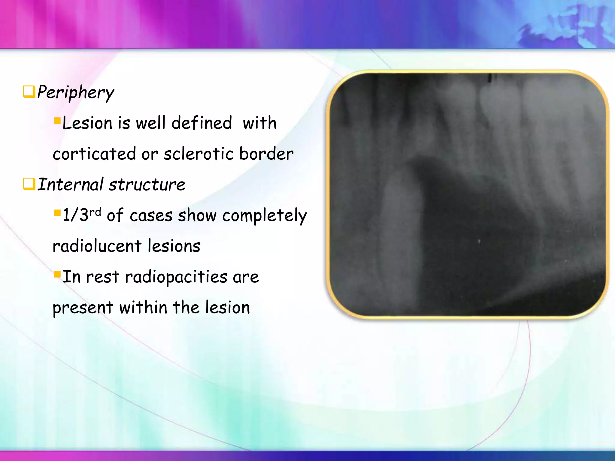 Periphery
Lesion is well defined with
corticated or sclerotic border
Internal structure
1/3rd of cases show completely
radiolucent lesions
In rest radiopacities are
present within the lesion
 