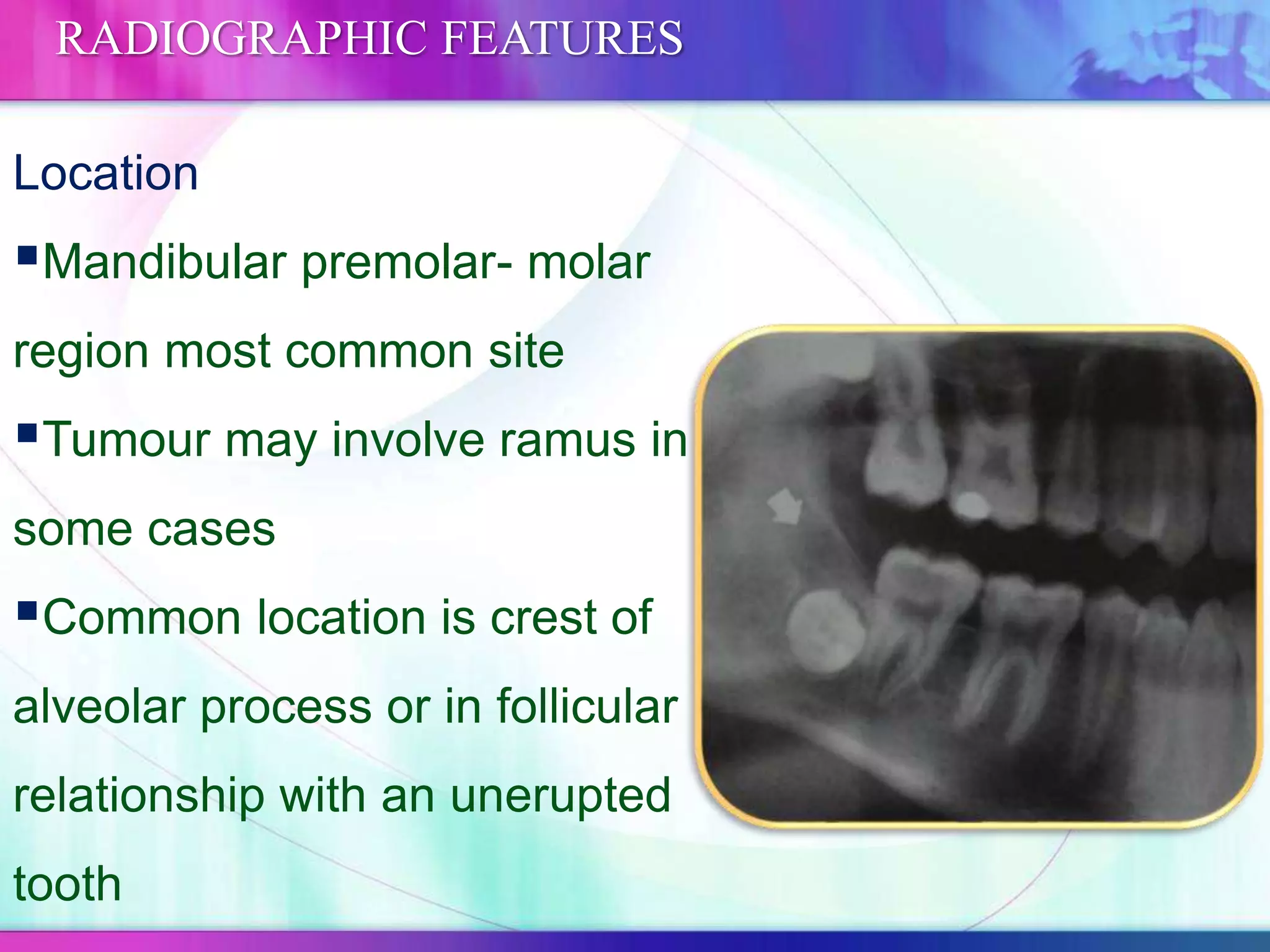 Location
Mandibular premolar- molar
region most common site
Tumour may involve ramus in
some cases
Common location is crest of
alveolar process or in follicular
relationship with an unerupted
tooth
RADIOGRAPHIC FEATURES
 