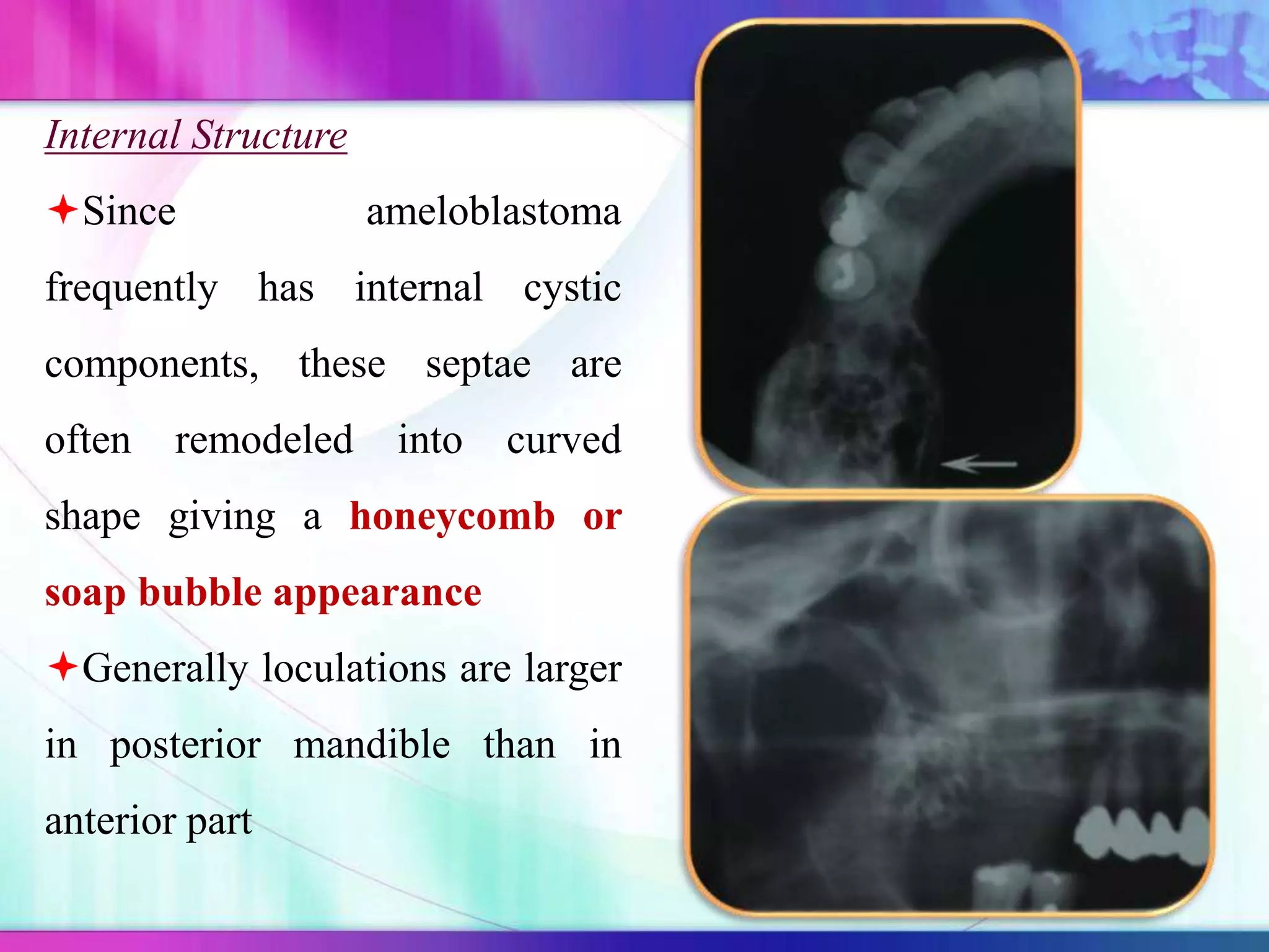 Internal Structure
Since ameloblastoma
frequently has internal cystic
components, these septae are
often remodeled into curved
shape giving a honeycomb or
soap bubble appearance
Generally loculations are larger
in posterior mandible than in
anterior part
 