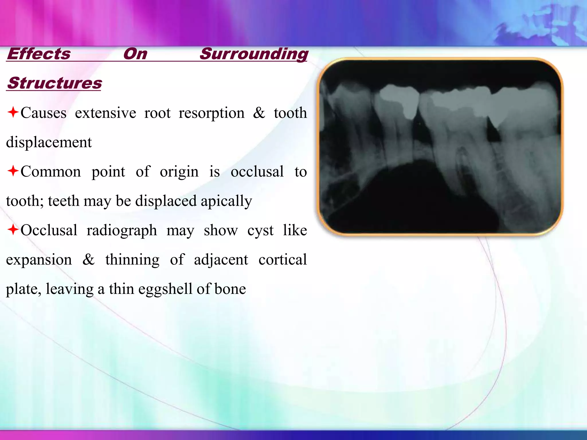 Effects On Surrounding
Structures
Causes extensive root resorption & tooth
displacement
Common point of origin is occlusal to
tooth; teeth may be displaced apically
Occlusal radiograph may show cyst like
expansion & thinning of adjacent cortical
plate, leaving a thin eggshell of bone
 