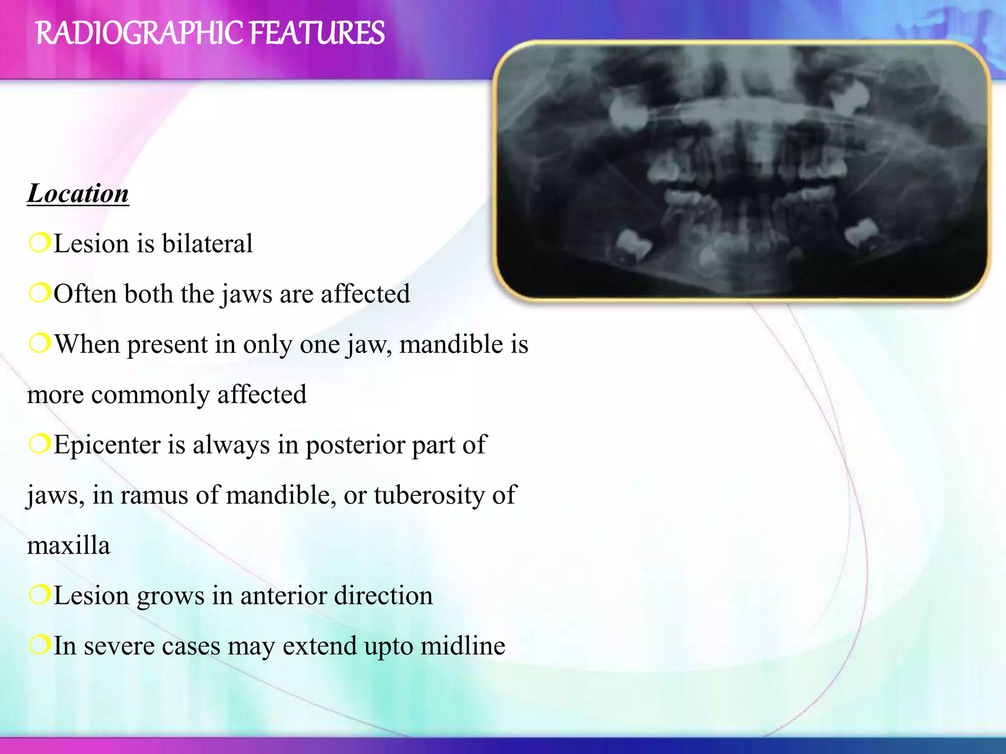 Location
Lesion is bilateral
Often both the jaws are affected
When present in only one jaw, mandible is
more commonly affected
Epicenter is always in posterior part of
jaws, in ramus of mandible, or tuberosity of
maxilla
Lesion grows in anterior direction
In severe cases may extend upto midline
RADIOGRAPHICFEATURES
 