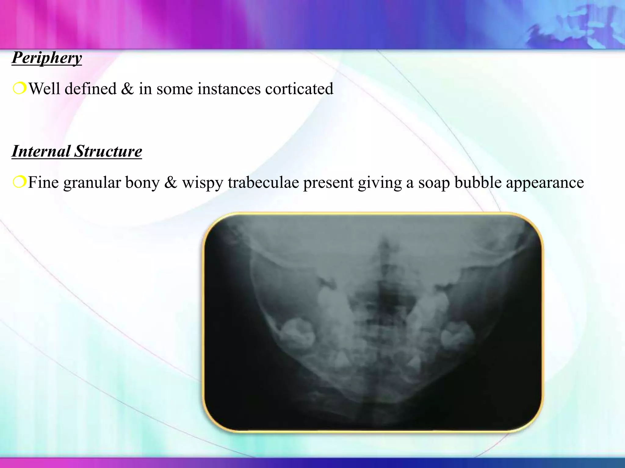 Periphery
Well defined & in some instances corticated
Internal Structure
Fine granular bony & wispy trabeculae present giving a soap bubble appearance
 