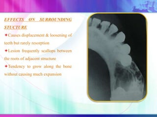 EFFECTS ON SURROUNDING
STUCTURE
Causes displacement & loosening of
teeth but rarely resorption
Lesion frequently scallops between
the roots of adjacent structure
Tendency to grow along the bone
without causing much expansion
 