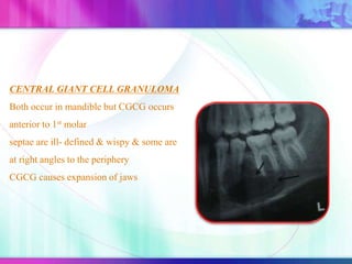 CENTRAL GIANT CELL GRANULOMA
Both occur in mandible but CGCG occurs
anterior to 1st molar
septae are ill- defined & wispy & some are
at right angles to the periphery
CGCG causes expansion of jaws
 