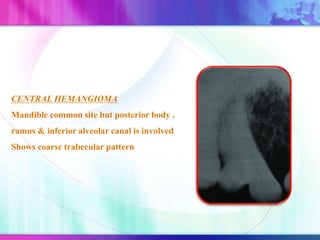 CENTRAL HEMANGIOMA
Mandible common site but posterior body ,
ramus & inferior alveolar canal is involved
Shows coarse trabecular pattern
 