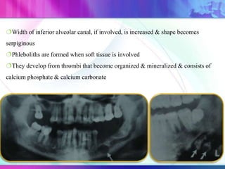 Width of inferior alveolar canal, if involved, is increased & shape becomes
serpiginous
Phleboliths are formed when soft tissue is involved
They develop from thrombi that become organized & mineralized & consists of
calcium phosphate & calcium carbonate
 