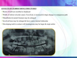EFFECTS ON SURROUNDING STRUCTURES
Roots of teeth are resorbed or displaced
Width of inferior alveolar canal, if involved, is increased & shape changes to serpiginous path
Mandibular & mental foramen may be enlarged
Involved bone may be enlarged & have coarse internal trabeculae
Developing teeth in contact with hemangioma may be larger & erupt earlier
 