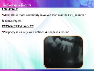 LOCATION
•Mandible is more commonly involved than maxilla (3:2) in molar
& ramus region
PERIPHERY & SHAPE
•Periphery is usually well defined & shape is circular.
Radiographic features
 