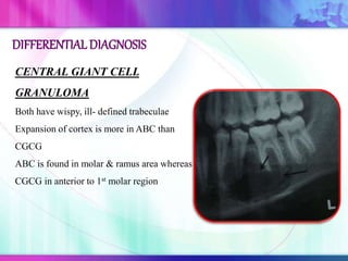 CENTRAL GIANT CELL
GRANULOMA
Both have wispy, ill- defined trabeculae
Expansion of cortex is more in ABC than
CGCG
ABC is found in molar & ramus area whereas
CGCG in anterior to 1st molar region
DIFFERENTIALDIAGNOSIS
 