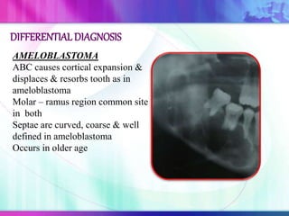 AMELOBLASTOMA
ABC causes cortical expansion &
displaces & resorbs tooth as in
ameloblastoma
Molar – ramus region common site
in both
Septae are curved, coarse & well
defined in ameloblastoma
Occurs in older age
DIFFERENTIALDIAGNOSIS
 
