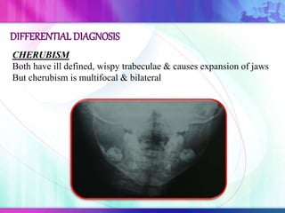 CHERUBISM
Both have ill defined, wispy trabeculae & causes expansion of jaws
But cherubism is multifocal & bilateral
DIFFERENTIALDIAGNOSIS
 