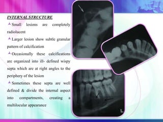 INTERNAL STRUCTURE
Small lesions are completely
radiolucent
Larger lesion show subtle granular
pattern of calcification
Occasionally these calcifications
are organized into ill- defined wispy
septa which are at right angles to the
periphery of the lesion
Sometimes these septa are well
defined & divide the internal aspect
into compartments, creating a
multilocular appearance
 