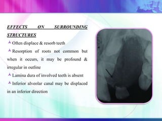EFFECTS ON SURROUNDING
STRUCTURES
Often displace & resorb teeth
Resorption of roots not common but
when it occurs, it may be profound &
irregular in outline
Lamina dura of involved teeth is absent
Inferior alveolar canal may be displaced
in an inferior direction
 