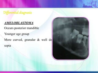Differential diagnosis
AMELOBLASTOMA
Occurs posterior mandible
Younger age group
More curved, granular & well defined
septa
 