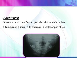 CHERUBISM
Internal structure has fine, wispy trabeculae as in cherubism
Cherubism is bilateral with epicenter in posterior part of jaw
 