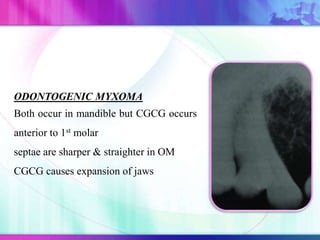 ODONTOGENIC MYXOMA
Both occur in mandible but CGCG occurs
anterior to 1st molar
septae are sharper & straighter in OM
CGCG causes expansion of jaws
 