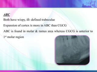 ABC
Both have wispy, ill- defined trabeculae
Expansion of cortex is more in ABC than CGCG
ABC is found in molar & ramus area whereas CGCG is anterior to
1st molar region
 
