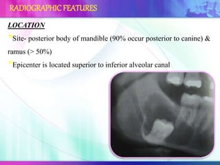 LOCATION
*Site- posterior body of mandible (90% occur posterior to canine) &
ramus (> 50%)
*Epicenter is located superior to inferior alveolar canal
RADIOGRAPHIC FEATURES
 