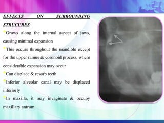 EFFECTS ON SURROUNDING
STRUCURES
*Grows along the internal aspect of jaws,
causing minimal expansion
*This occurs throughout the mandible except
for the upper ramus & coronoid process, where
considerable expansion may occur
*Can displace & resorb teeth
*Inferior alveolar canal may be displaced
inferiorly
*In maxilla, it may invaginate & occupy
maxillary antrum
 