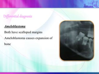 Ameloblastoma
Both have scalloped margins
Ameloblastoma causes expansion of
bone
Differential diagnosis
 