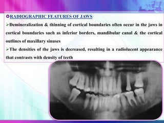 RADIOGRAPHIC FEATURES OF JAWS
Demineralization & thinning of cortical boundaries often occur in the jaws in
cortical boundaries such as inferior borders, mandibular canal & the cortical
outlines of maxillary sinuses
The densities of the jaws is decreased, resulting in a radiolucent appearance
that contrasts with density of teeth
 