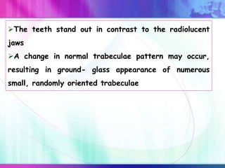 The teeth stand out in contrast to the radiolucent
jaws
A change in normal trabeculae pattern may occur,
resulting in ground- glass appearance of numerous
small, randomly oriented trabeculae
 