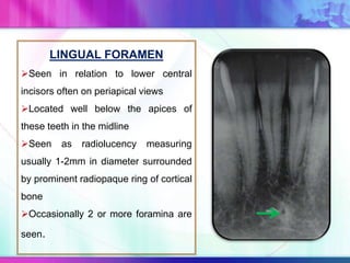 LINGUAL FORAMEN
Seen in relation to lower central
incisors often on periapical views
Located well below the apices of
these teeth in the midline
Seen as radiolucency measuring
usually 1-2mm in diameter surrounded
by prominent radiopaque ring of cortical
bone
Occasionally 2 or more foramina are
seen.
 