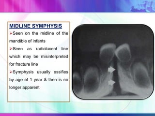 MIDLINE SYMPHYSIS
Seen on the midline of the
mandible of infants
Seen as radiolucent line
which may be misinterpreted
for fracture line
Symphysis usually ossifies
by age of 1 year & then is no
longer apparent
 