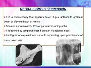 MEDIAL SIGMOID DEPRESSION
It is a radiolucency that appears below & just anterior to greatest
depth of sigmoid notch of ramus
Seen on approximately 10% of panoramic radiographs
It is defined by temporal crest & crest of mandibular neck
Its degree of expression is variable depending upon prominence of
these two crests.
 