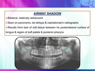 AIRWAY SHADOW
Bilateral, relatively radiolucent
Seen on panoramic, lat oblique & cephalomatric radiographs
Results from lack of soft tissue between he posterolateral surface of
tongue & region of soft palate & posterior pharynx
 