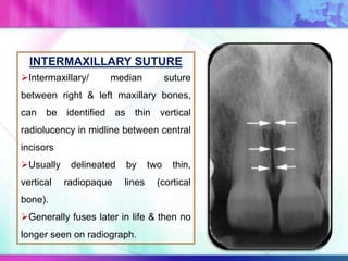 INTERMAXILLARY SUTURE
Intermaxillary/ median suture
between right & left maxillary bones,
can be identified as thin vertical
radiolucency in midline between central
incisors
Usually delineated by two thin,
vertical radiopaque lines (cortical
bone).
Generally fuses later in life & then no
longer seen on radiograph.
 