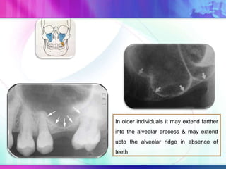 In older individuals it may extend farther
into the alveolar process & may extend
upto the alveolar ridge in absence of
teeth
 