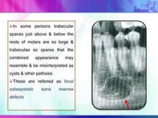 In some persons trabecular
spaces just above & below the
roots of molars are so large &
trabeculae so sparse that the
combined appearance may
resemble & be misinterpreted as
cysts & other pathosis
These are referred as focal
osteoporotic bone marrow
defects
 