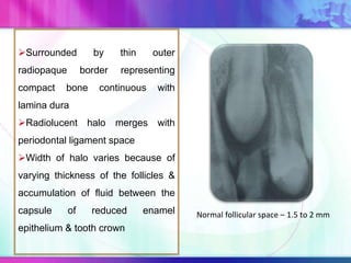 Surrounded by thin outer
radiopaque border representing
compact bone continuous with
lamina dura
Radiolucent halo merges with
periodontal ligament space
Width of halo varies because of
varying thickness of the follicles &
accumulation of fluid between the
capsule of reduced enamel
epithelium & tooth crown
Normal follicular space – 1.5 to 2 mm
 