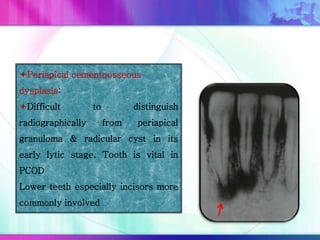 Periapical cementoosseous
dysplasia:
Difficult to distinguish
radiographically from periapical
granuloma & radicular cyst in its
early lytic stage. Tooth is vital in
PCOD
Lower teeth especially incisors more
commonly involved
 