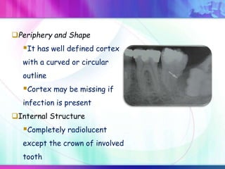 Periphery and Shape
It has well defined cortex
with a curved or circular
outline
Cortex may be missing if
infection is present
Internal Structure
Completely radiolucent
except the crown of involved
tooth
 