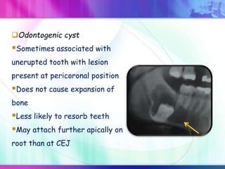 Odontogenic cyst
Sometimes associated with
unerupted tooth with lesion
present at pericoronal position
Does not cause expansion of
bone
Less likely to resorb teeth
May attach further apically on
root than at CEJ
 