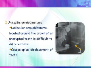 Unicystic ameloblastoma
Unilocular ameloblastoma
located around the crown of an
unerupted tooth is difficult to
differentiate
Causes apical displacement of
teeth
 