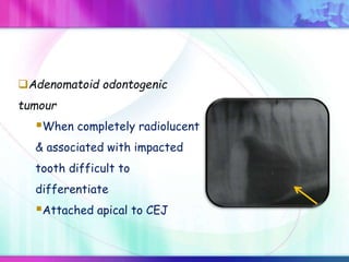 Adenomatoid odontogenic
tumour
When completely radiolucent
& associated with impacted
tooth difficult to
differentiate
Attached apical to CEJ
 