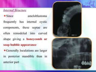 Internal Structure
Since ameloblastoma
frequently has internal cystic
components, these septae are
often remodeled into curved
shape giving a honeycomb or
soap bubble appearance
Generally loculations are larger
in posterior mandible than in
anterior part
 