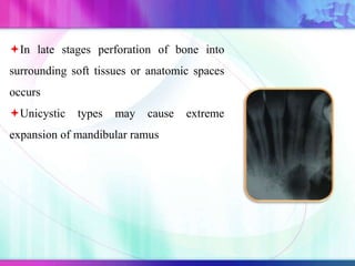 In late stages perforation of bone into
surrounding soft tissues or anatomic spaces
occurs
Unicystic types may cause extreme
expansion of mandibular ramus
 