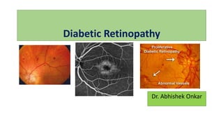 Diabetic Retinopathy
Dr. Abhishek Onkar
 