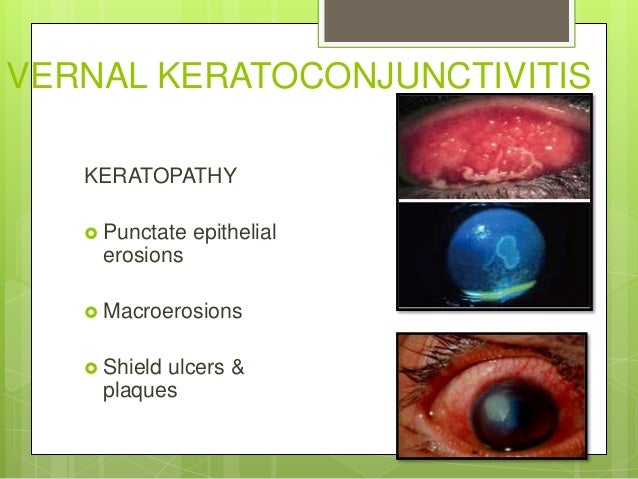 Dr.s.veni priya17.2.16 ni conj & xerophthalmia