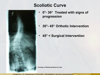 Funded by: U.S. Department of Education, Rehabilitation Services Administration Award # H235J050020
Scoliotic Curve
• 0°- 30° Treated with signs of
progression
• 30°- 45° Orthotic Intervention
• 45° < Surgical Intervention
Courtesy of Westcoast Brace & Limb
 