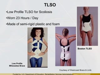 Funded by: U.S. Department of Education, Rehabilitation Services Administration Award # H235J050020
TLSO
Low ProfileLow Profile
Milwaukee BraceMilwaukee Brace
Boston TLSOBoston TLSO
•Low Profile TLSO for Scoliosis
•Worn 23 Hours / Day
•Made of semi-rigid plastic and foam
Courtesy of Westcoast Brace & Limb
 