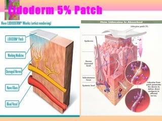 Lidoderm 5% Patch
 