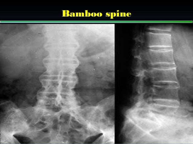 Dr tarek spondyloarthropathy Dr tarek spondyloarthropathy