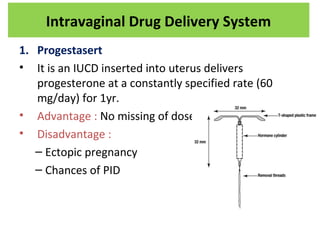 1. Progestasert
• It is an IUCD inserted into uterus delivers
progesterone at a constantly specified rate (60
mg/day) for 1yr.
• Advantage : No missing of dose
• Disadvantage :
– Ectopic pregnancy
– Chances of PID
Intravaginal Drug Delivery System
 
