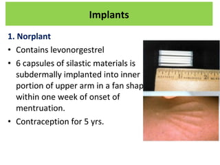 1. Norplant
• Contains levonorgestrel
• 6 capsules of silastic materials is
subdermally implanted into inner
portion of upper arm in a fan shape
within one week of onset of
mentruation.
• Contraception for 5 yrs.
Implants
 