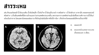 เช่น ทินเนอร์ผสมสี น้ามันเบนซิน น้ามันไฟแช็ก น้ามันก๊าด น้ามันแล็กเกอร์ กาวชนิดต่าง ๆ น้ามันชักเงา ยาทาเล็บ ตลอดจนสเปรย์
ชนิดต่าง ๆ เป็นสิ่งเสพติดที่มีความร้ายแรงกว่าสารเสพติดประเภทอื่น เพราะนอกจากเสพติดง่ายแล้วยังทิ้งความพิการถาวรไว้ให้แก่
อวัยวะในร่างกาย โดยเฉพาะโรคสมองฝ่อถาวร ซึ่งปัจจุบันยังไม่มียาหรือวิธีการใด ๆ ที่จะรักษาโรคสมองฝ่อให้หายเป็นปกติได้
A. สมองปกติ
B. สมองหลังเสพสารระเหย
เป็นระยะเวลา 2 เดือน .
 
